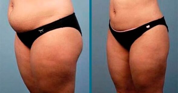 Methoden zum Abnehmen um 10 Kilogramm in einem Monat